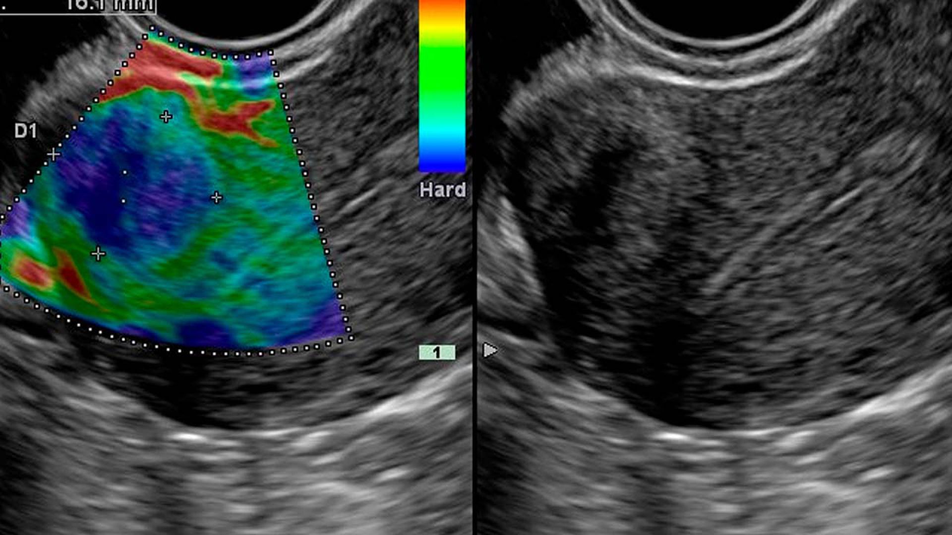 Эластография!!! Новый революционный метод диагностики.